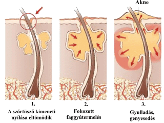Az akne, mitesszer, serdlkori pattans kialakulsa