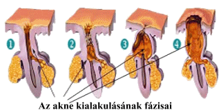 Az akne, mitesszer, pattans kialakulsnak fzisai