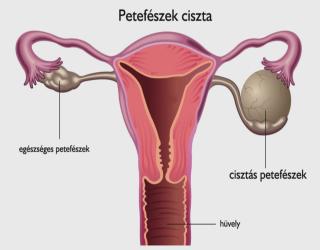 fájdalom a ciszta prosztataban