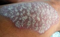 Pikkelysmr (psoriasis)