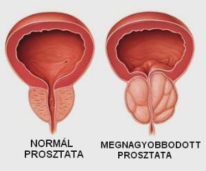 Pszichoszomatika s a prosztata