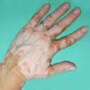 Vitiligo: Segt-e az nismereti, szemlyisgfejleszt, stresszolds trning?